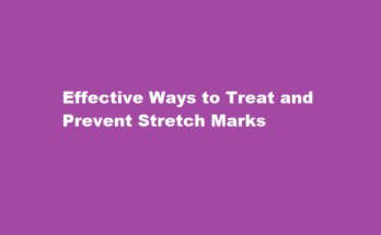 how to cure stretch marks