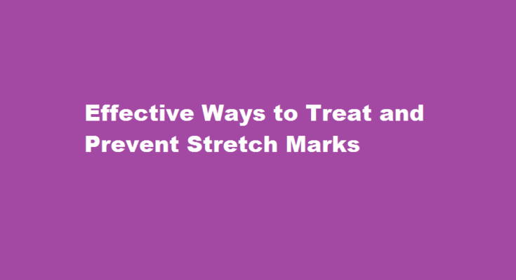 how to cure stretch marks