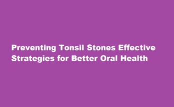 how to prevent tonsil stones