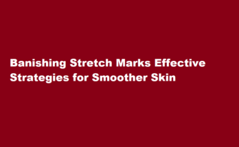 how to get rid of stretch marks